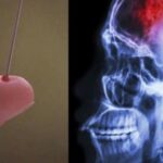 Інсульт — знаючи, що можна рятувати своїх близьких!