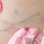 Домашня мазь від варикозу, яка врятувала мою маму від операції